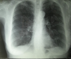 Reabilitação Pulmonar em Paciente DPOC com Exacerbação Aguda por Infecção Respiratória