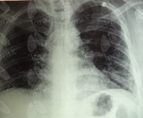 Reabilitação Pulmonar em Paciente com Sequela Pulmonar Grave Pós-Infecção por H1N1